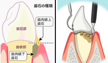 歯周治療