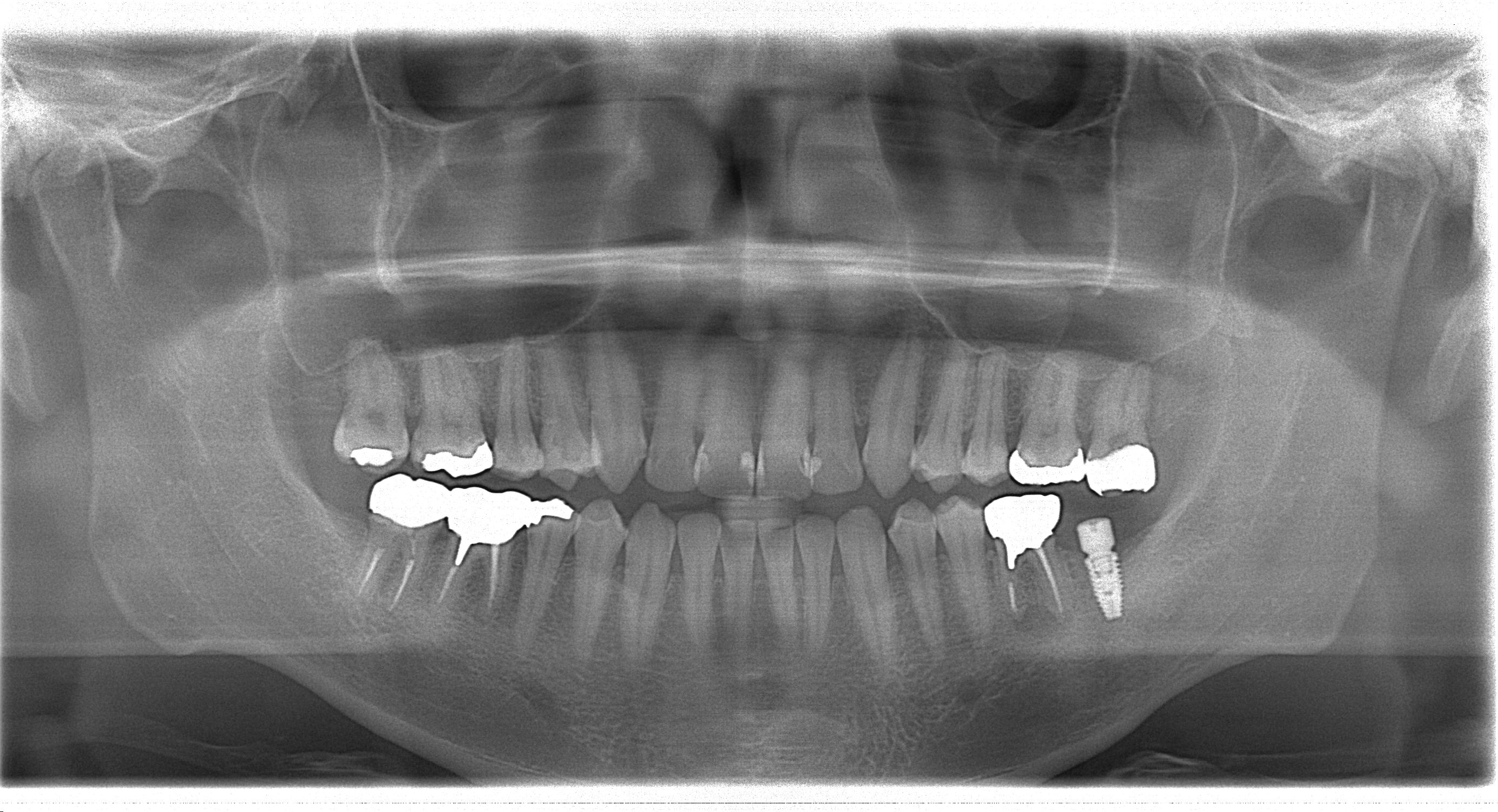 インプラントパノラマ