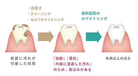 ホワイトニング