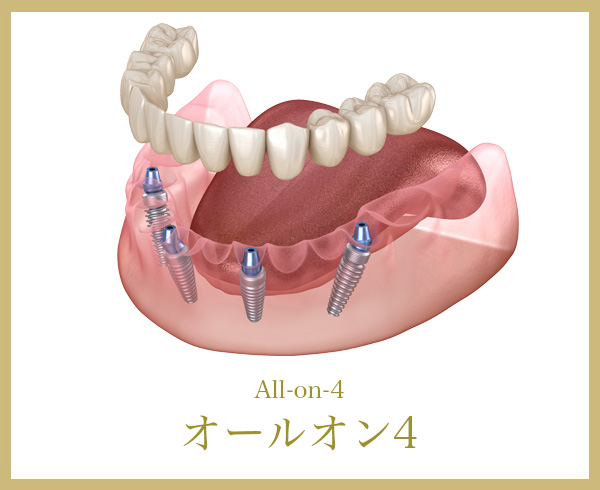 オールオン4のイメージ画像