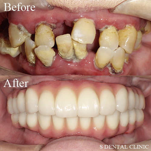 上下顎のオールオン4治療