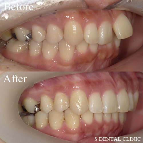 出っ歯が気になる(１本だけ出ているケース)