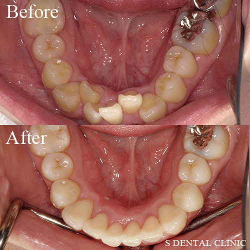 歯を抜かずに出っ歯を改善