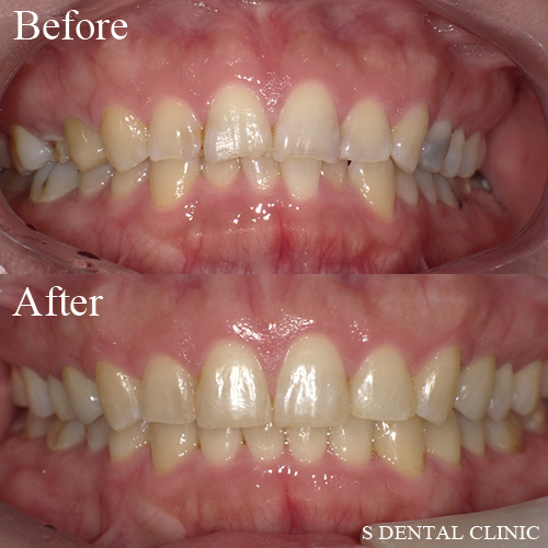 前歯の叢生（デコボコ）の矯正治療と虫歯治療