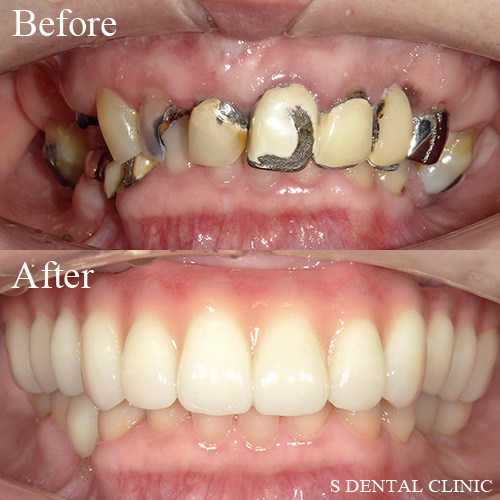 上顎オールオン４と下顎インプラント埋入