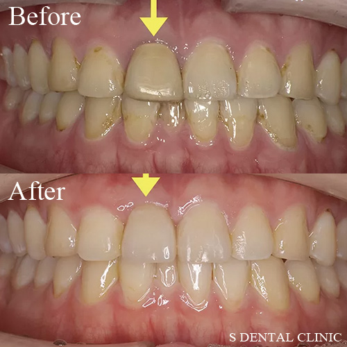 右上前歯の抜歯即時埋入