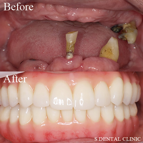 ボロボロな歯の解決（オールオン４）