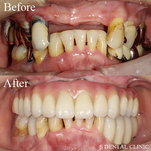 上顎オールオン4及び下顎臼歯のインプラント