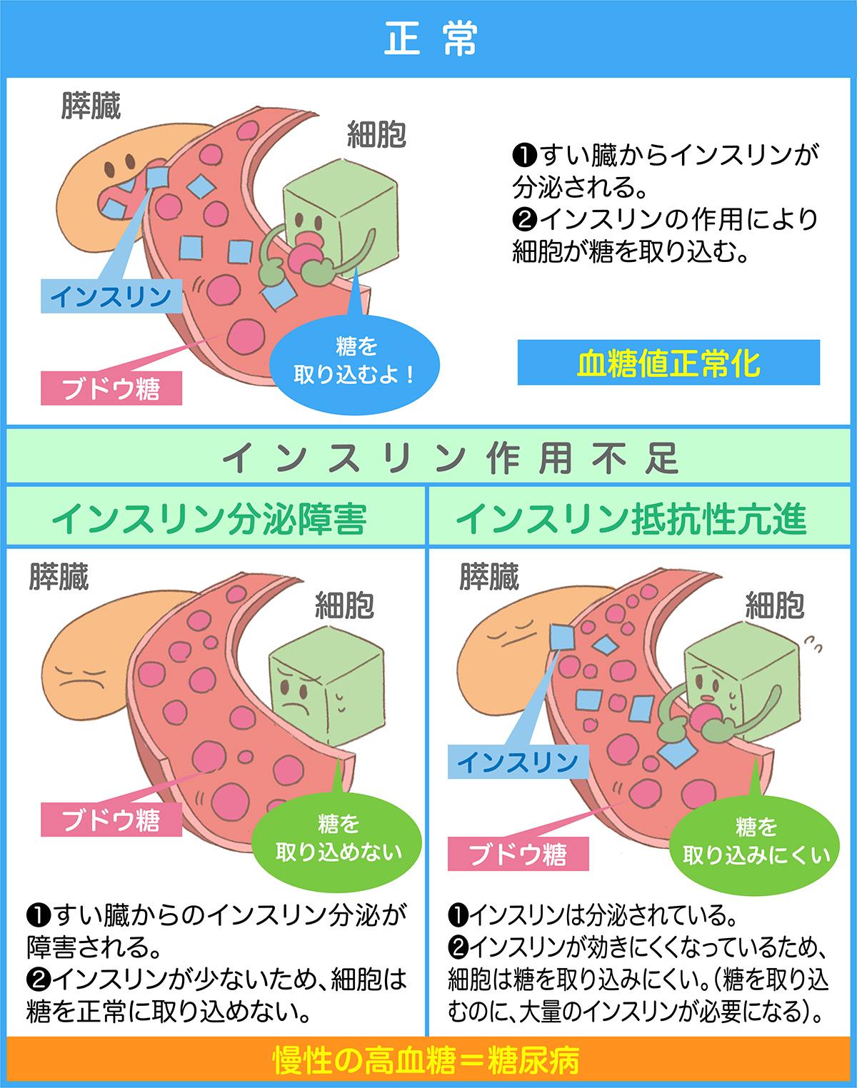 歯周病と糖尿病 画像